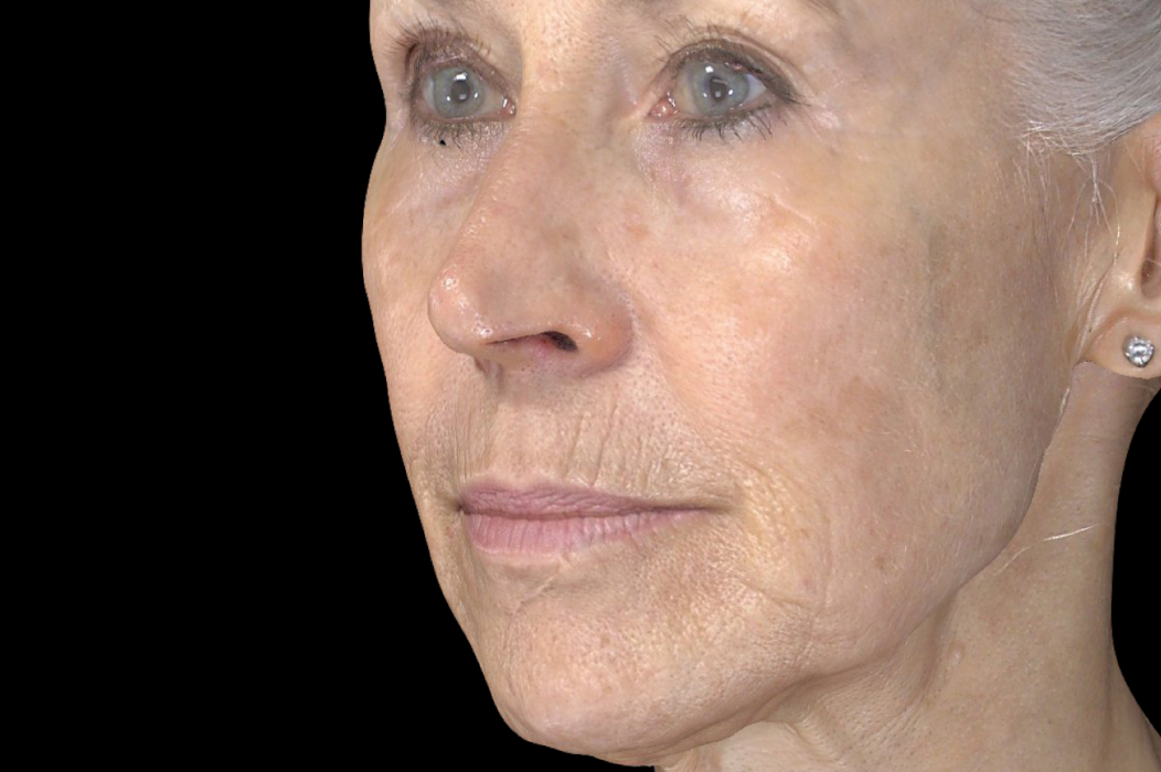 exion radiofrequence microneedling